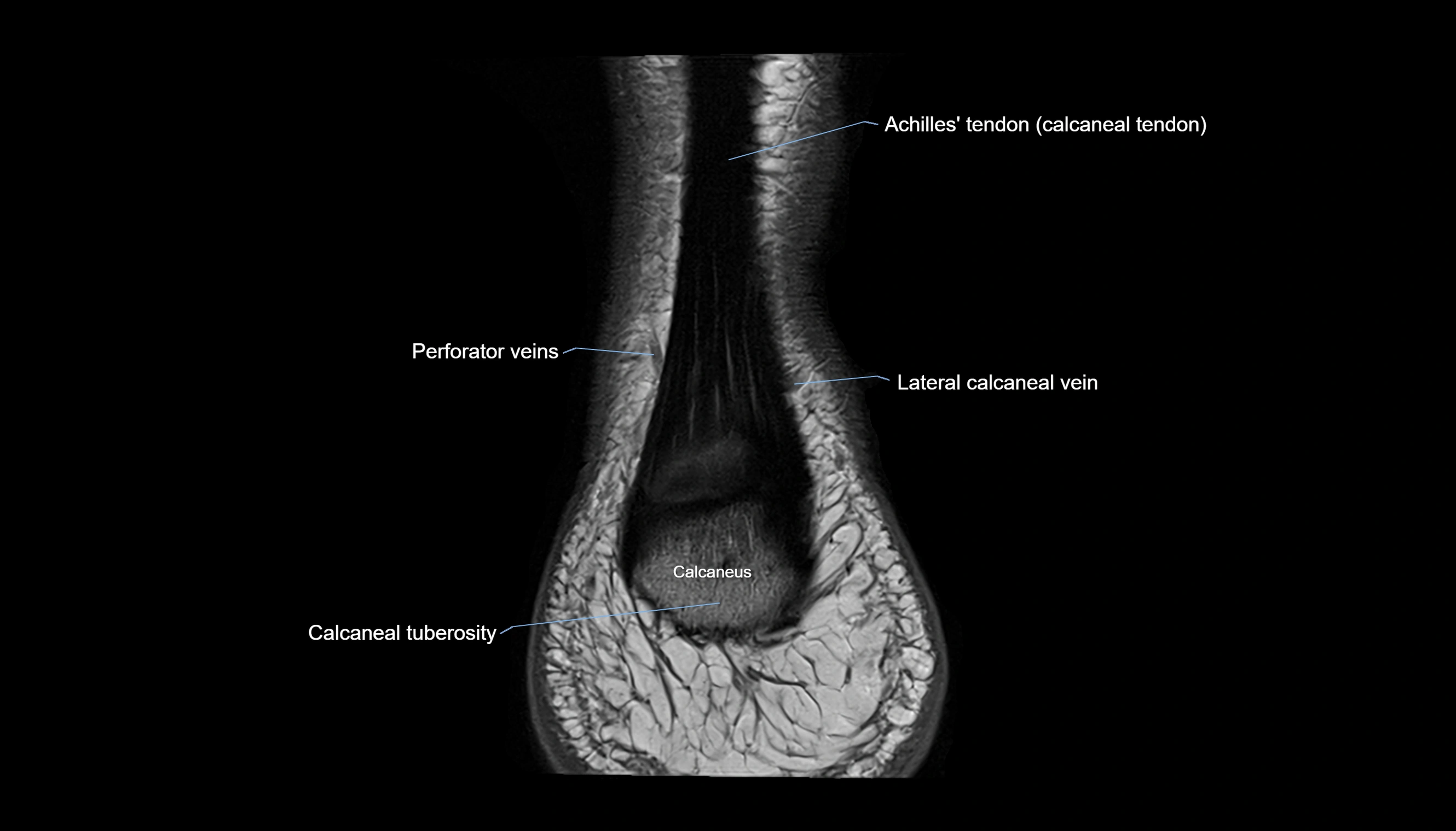 Ankle coronal anatomy 3T MRI images -img-11001-00031.webp